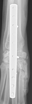 Postoperative radiograph after pancarpal arthrodesis