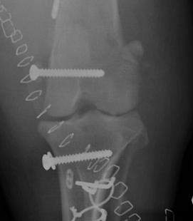 Reconstructed joint following surgery.