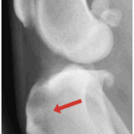 Tibia displaced forward during weight-bearing with CCL rupture