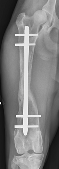 Interlocking nail used for a femoral fracture
