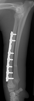Plate fixation of an antebrachial fracture