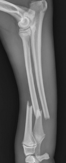 Radius and ulna fracture in a dog