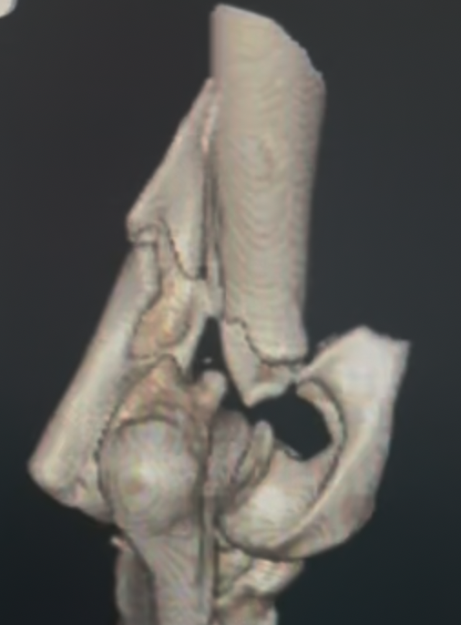 CT scan of a bicondylar fracture