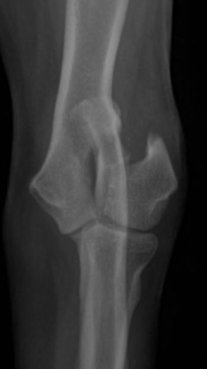 Unicondylar fracture radiograph
