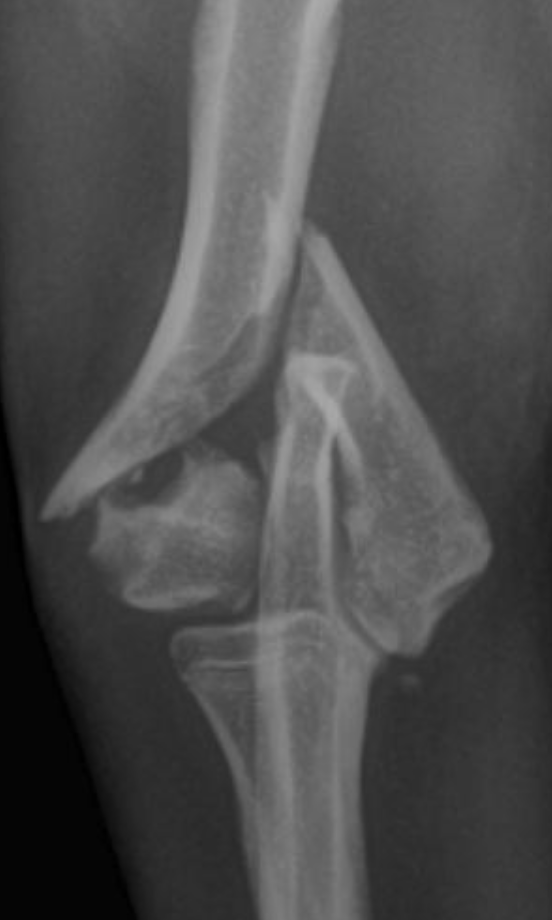 Bicondylar fracture radiograph