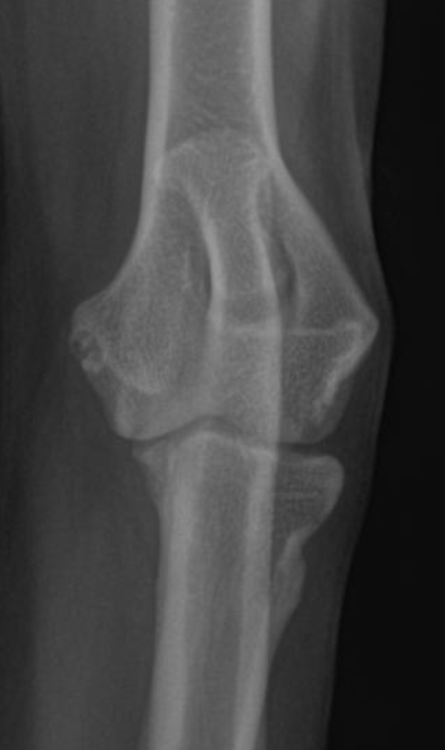 Normal elbow radiograph