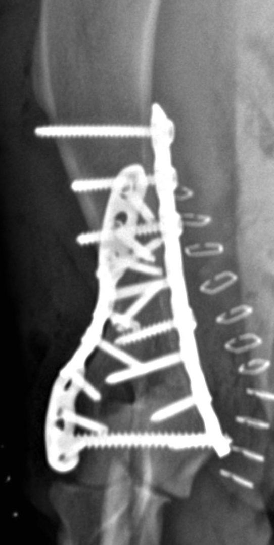 Complex bicondylar fracture repair with implants